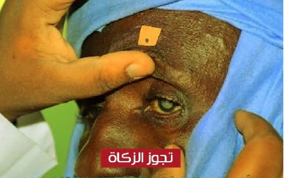 Eye surgeries in Africa for the poor and needy - Sheikh Abdullah Al Nouri Charity Society